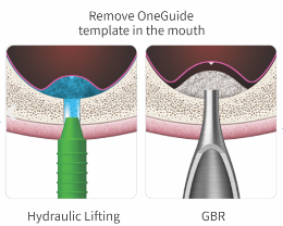 Accurate and safe implantation