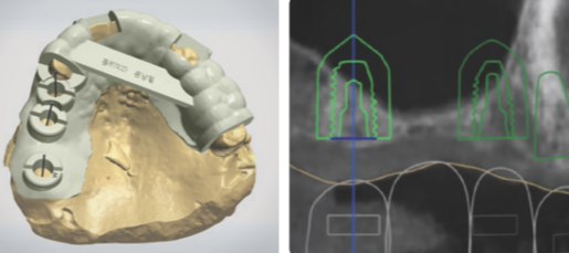 Decide implant position