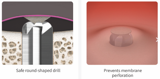Sinus lifting without