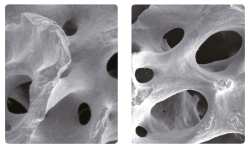 Bone Regeneration