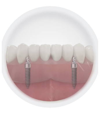 Denture Type