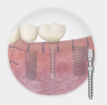 EM Implant Provisional