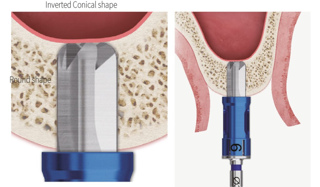 Prevents perforation