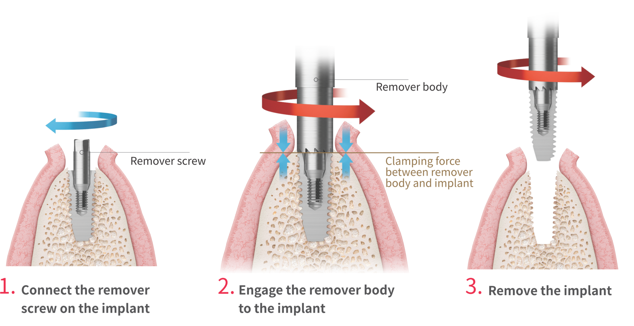 Remove failing or misplaced implants in only 3 steps