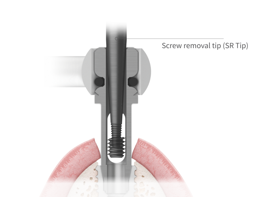 2. Removing a fractured screw