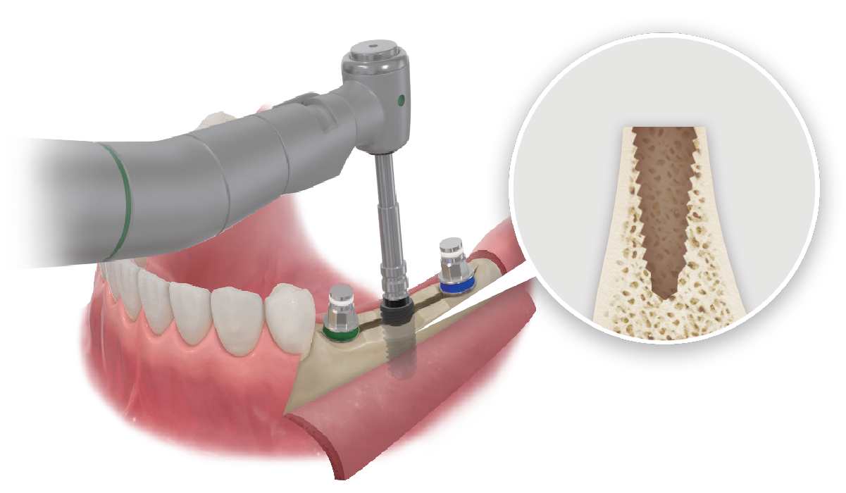 Place implants without excess torque