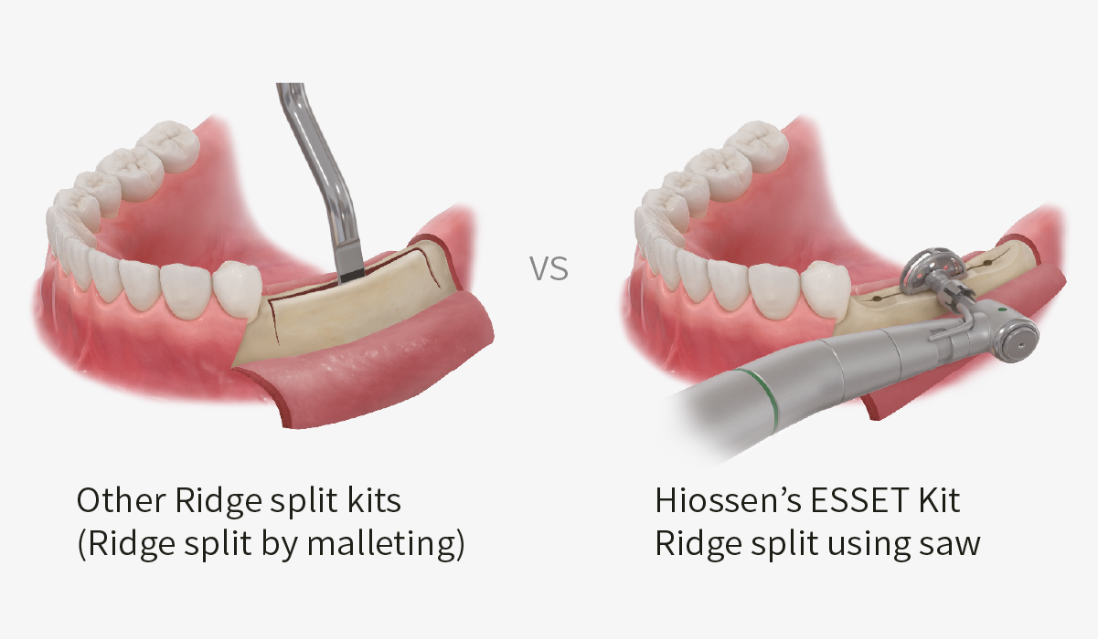 Ridge split surgery