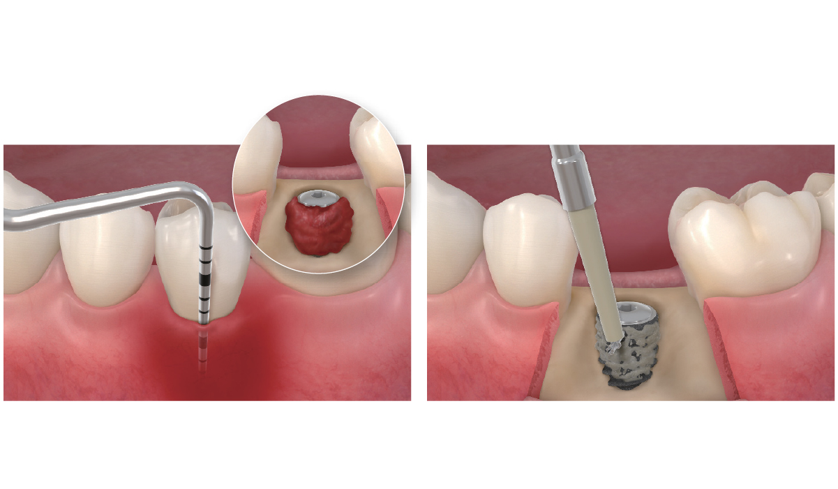 Peri implantitis with horizontal bone resorption